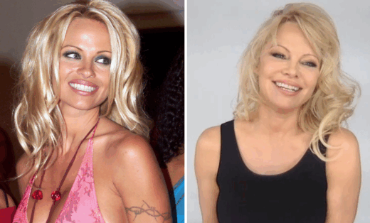 Pamela Anderson Breast Augmentation and Reduction