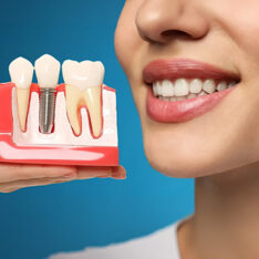 schraubenlose zahnimplantate​