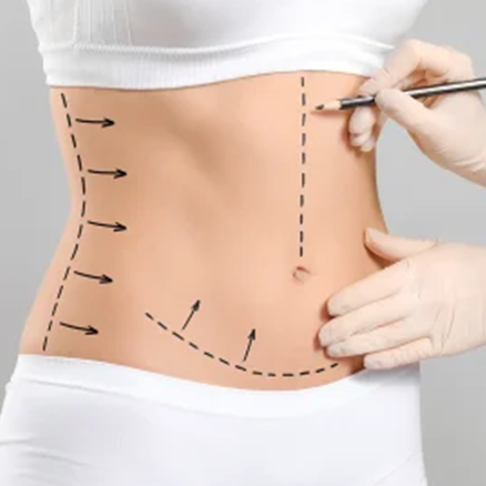 Mini Abdominoplasty: When a Limited Problem Needs a Precise Solution