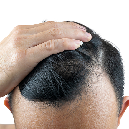 Haartransplantation Grafts: Die Basis für dichte Ergebnisse