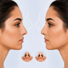 Rhinoplasty Crooked Nose