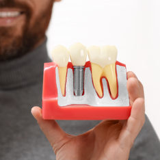 quanto dura un impianto dentale