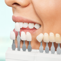 quanto durano le faccette dentali