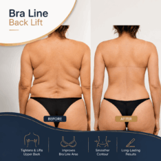 Bra Line Back Lift