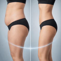 Vaser Liposuktion