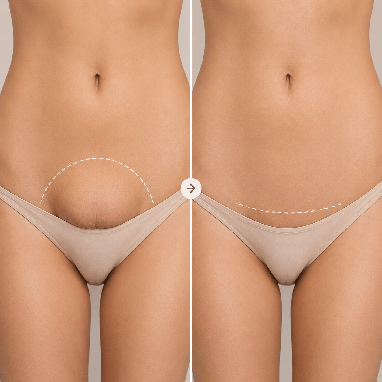 Monsplasty: 3 stages of tissue healing and recovery